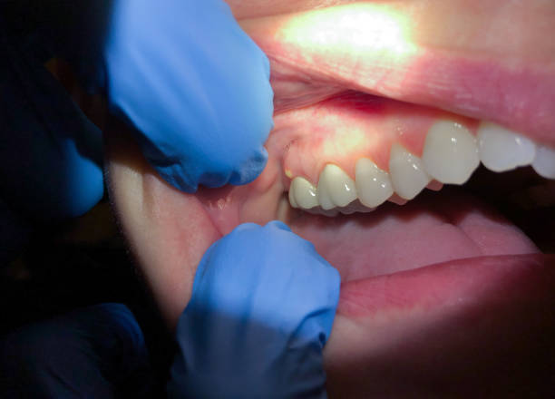 Best Emergency Denture Repair in Leominster, MA